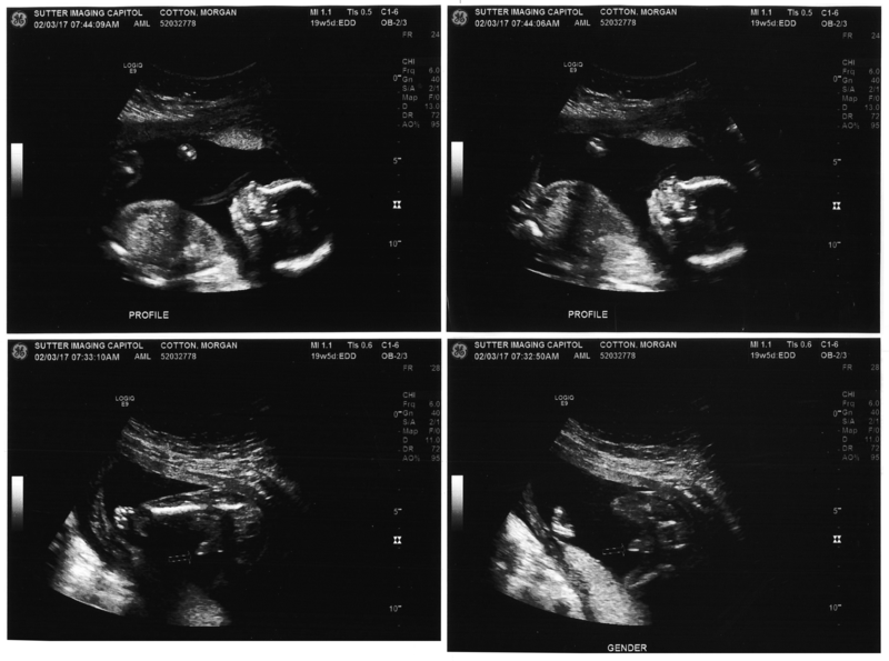 2017-04-04-aureliano-ultrasound.png